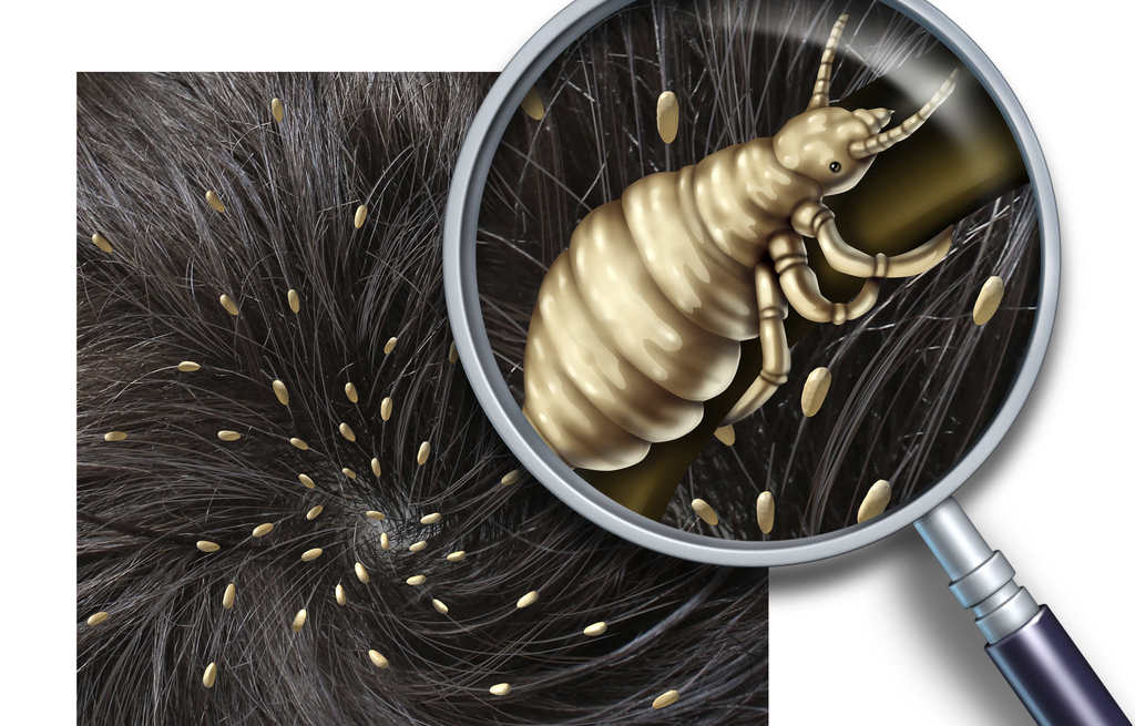 Los-piojos-unos-parasitos-indeseables-1